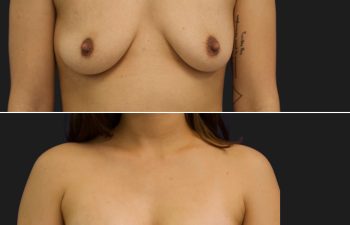0 year-old before and 17 days after breast augmentation