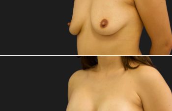 0 year-old before and 17 days after breast augmentation
