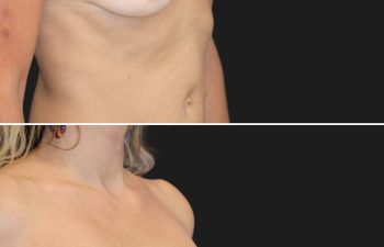45 year-old before and 2 months after breast augumentation