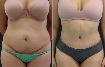 33 year old before and 6 months after a Tummy Tuck, Liposuction of the Flanks, Upper Back and Brazilian Butt Lift BBL Fat Transfer to the Buttocks