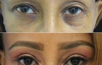 53 year-old before and 2 months after awake upper eyelid lift