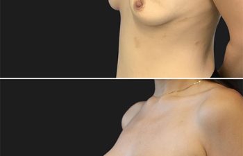 30 year-old patient before and after breast augmentation
