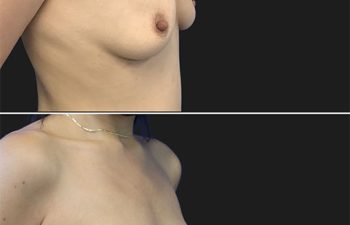 30 year-old patient before and after breast augmentation