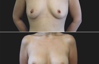 30 year-old patient before and after breast augmentation