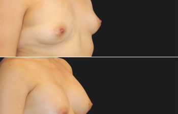 before and after breast augmentation procedure