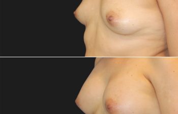 before and after breast augmentation procedure