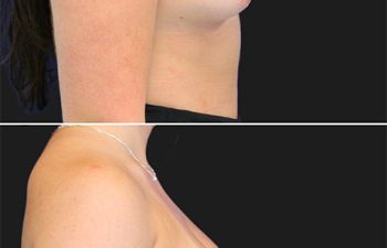 before and after breast augmentation procedure