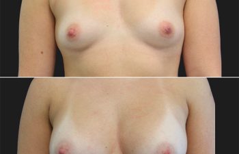 before and after breast augmentation procedure