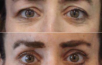 48 year old before and 2 months after awake upper eyelid lift in Tysons Corner, VA