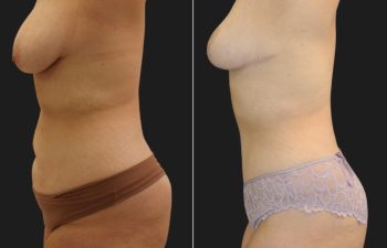 Tummy Tuck after Weight-Loss: 29 year old before and 5 months after an extended tummy tuck and breast lift