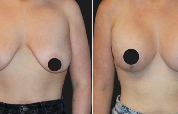 25 years old after massive weight loss, before and 3 months after breast lift with augmentation (350 CC Silicone Implants)