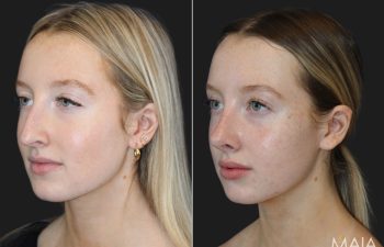 17 year-old patient before and 6 months after rhinoplasty