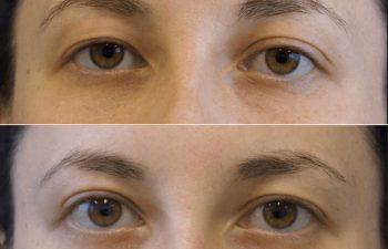 26 years old before and 2 months after unilateral upper blepharoplasty (Right Side)
