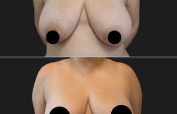 27 year-old before and 6 months after 360 Liposuction and Breast Reduction