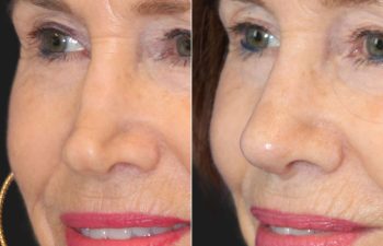 71 year-old patient before and 6 Weeks After Revision Rhinoplasty - Collapsed Valve Repair. Final Results Expected in 1 Year.