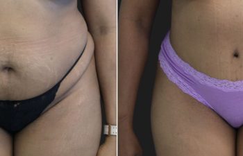 46 Year Old Before and 6 Months After An Extended Abdominoplasty and Liposuction of Flanks & Lateral Chest.