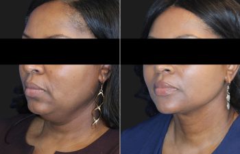 50 year-old patient before and 3 months after a deep plane neck lift and neck liposuction