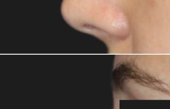 17 Year-Old Before and 7 Weeks After Rhinoplasty | Final Results Expected in 1 Year