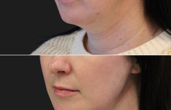 43 Year Old Before and 3 Months After Neck Lift