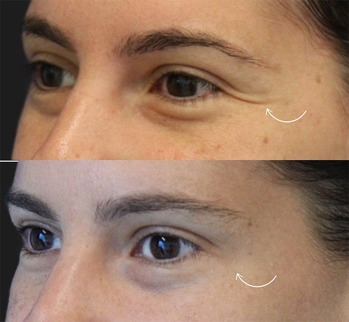 Before and after images of someone's eyes showing a reduction in wrinkles.