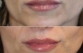 Before and after comparison of lips showing increased fullness and reduced lines, with the word "MAIA" in the lower right corner.