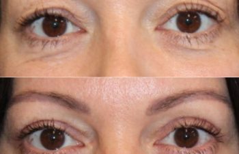 46 Year-Old Before and 3 Months After Awake Upper Eyelid Lift