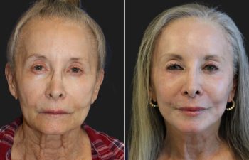 72 year-old patient before and 8 weeks after a deep plane facelift, deep plane neck lift, lower blepharoplasty, brow lift, fat grafting to the face, CO2 laser skin resurfacing, and a touch of lip filler.