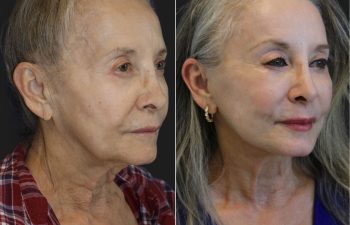 73-year-old patient before and 4 months post-op deep plane facelift.