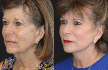 Side-by-side images of a woman before and after a cosmetic procedure; left shows her with natural makeup, right shows her with more makeup and smoother skin.