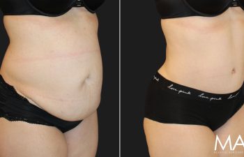 Two side-by-side images showing a woman's abdomen in underwear, before and after a cosmetic procedure. The "after" image shows a tighter, smoother abdominal appearance.