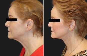 Side-by-side comparison of a woman's profile before and after cosmetic surgery, showing reduced neck sagging and more defined jawline.