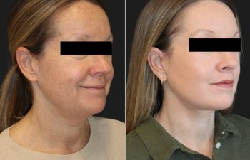Side-by-side comparison of a woman's face before and after a cosmetic procedure. In the after image, her skin appears smoother and tighter. Both images have the eyes blacked out for privacy.