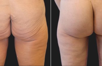 Before and 2 months after photos of a 43-year-old woman following a lower body lift, Brazilian Butt Lift (fat transfer to the buttocks), and thigh lift, showing enhanced body contour, lifted thighs, and improved buttock volume.