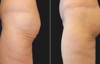 Before and 2 months after photos of a 43-year-old woman following a lower body lift, Brazilian Butt Lift (fat transfer to the buttocks), and thigh lift, showing enhanced body contour, lifted thighs, and improved buttock volume.