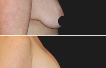 Side-by-side before and after images showing a woman's torso with breast changes following a cosmetic surgery procedure. Logo "MAIA Plastic Surgery & Skincare" is visible in the lower right corner.