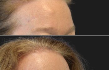 52 year old before and 2 months after osteoma removal