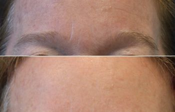 52 year old before and 2 months after osteoma removal