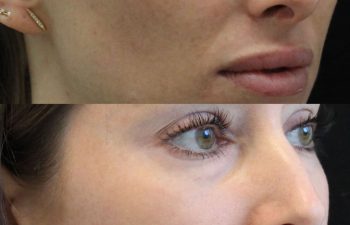 35-year-old woman before and 2 days after 1 CoolPeel treatment by Nurse Erin Ochs, showing improved pigmentation and skin tone with minimal downtime before her wedding.