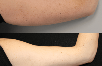 35-year-old woman before and 4 weeks after 1 IPL treatment on her arms by Nurse Erin Ochs, showing improved skin tone and reduced pigmentation before her wedding.