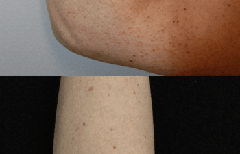 35-year-old woman before and 4 weeks after 1 IPL treatment on her arms by Nurse Erin Ochs, showing improved skin tone and reduced pigmentation before her wedding.