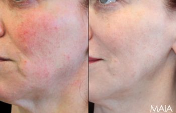 51-year-old female before and after IPL and CoolPeel treatments – noticeable improvement in skin tone, texture, redness, and pigmentation.
