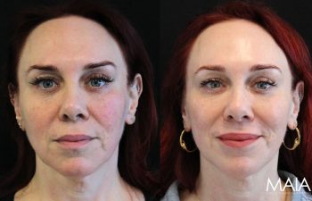 51-year-old female before and after IPL and CoolPeel treatments – noticeable improvement in skin tone, texture, redness, and pigmentation.