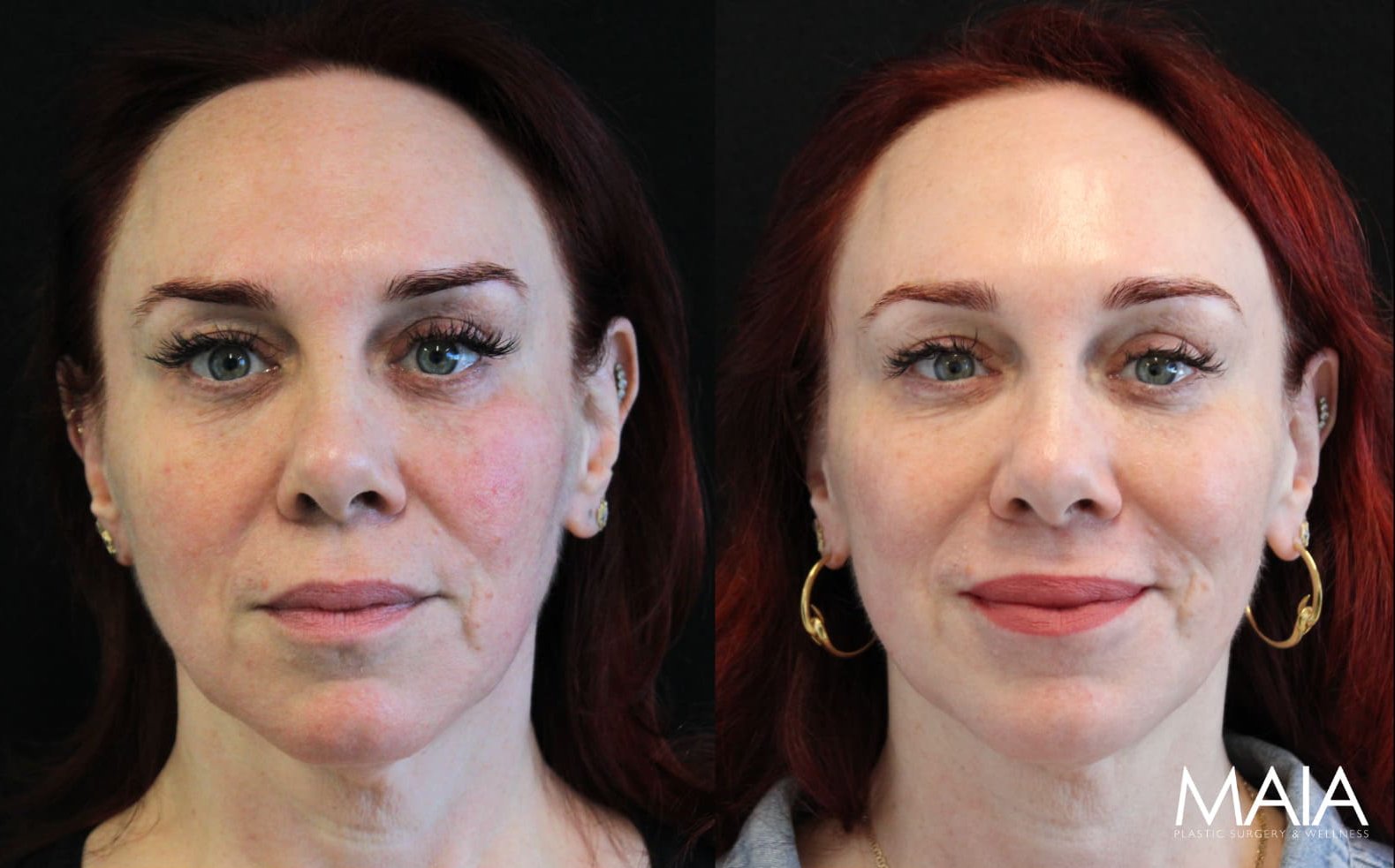 51-year-old female before and after IPL and CoolPeel treatments – noticeable improvement in skin tone, texture, redness, and pigmentation.