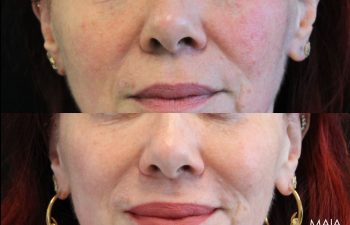51-year-old female before and after IPL and CoolPeel treatments – noticeable improvement in skin tone, texture, redness, and pigmentation.