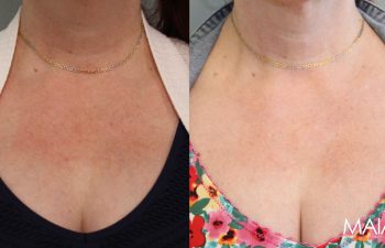 51-year-old female before and after IPL and CoolPeel treatments – noticeable improvement in skin tone, texture, redness, and pigmentation.