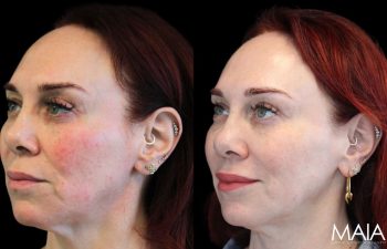 51-year-old female before and after IPL and CoolPeel treatments – noticeable improvement in skin tone, texture, redness, and pigmentation.