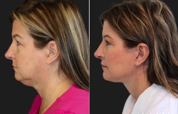 Side-by-side profile photos of a woman before and after a cosmetic procedure, showing a more defined jawline and smoother neck in the after image.