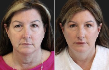 Side-by-side comparison of a woman before and after a cosmetic procedure, showing reduced under-eye bags and smoother skin on the right.