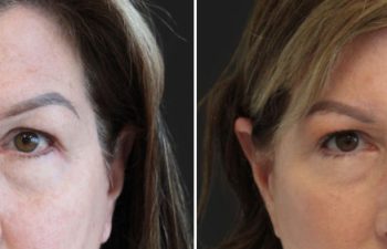 Side-by-side photos of a woman’s face before and after a cosmetic procedure; the after photo shows smoother skin and more lifted eyebrows.