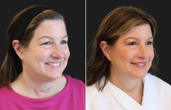 Side-by-side comparison of a woman before (left) and after (right) a cosmetic procedure, showing a visible reduction in facial wrinkles and improved skin tone.